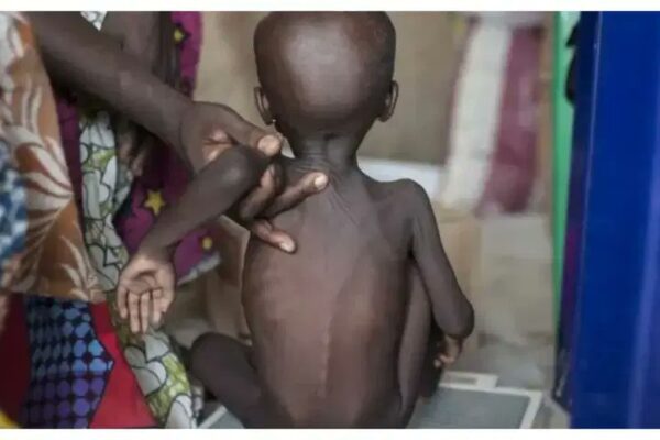 malnutrition