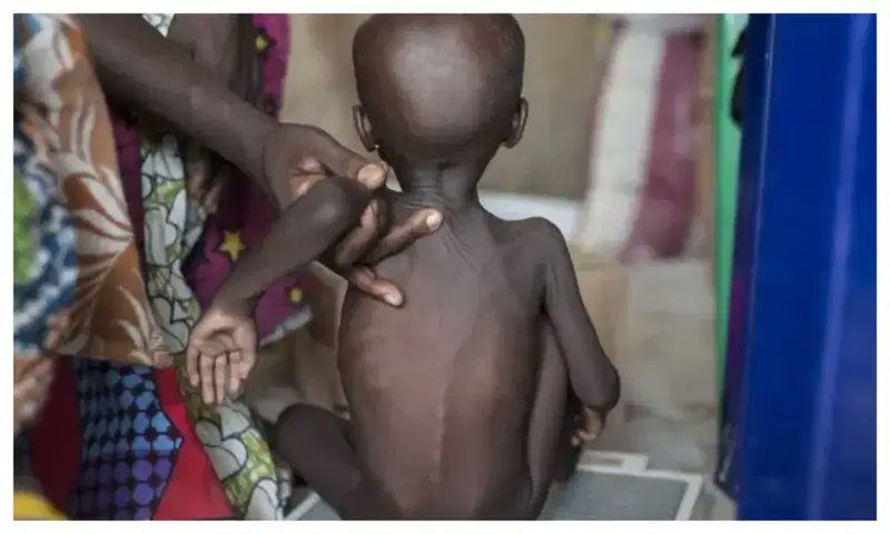 malnutrition